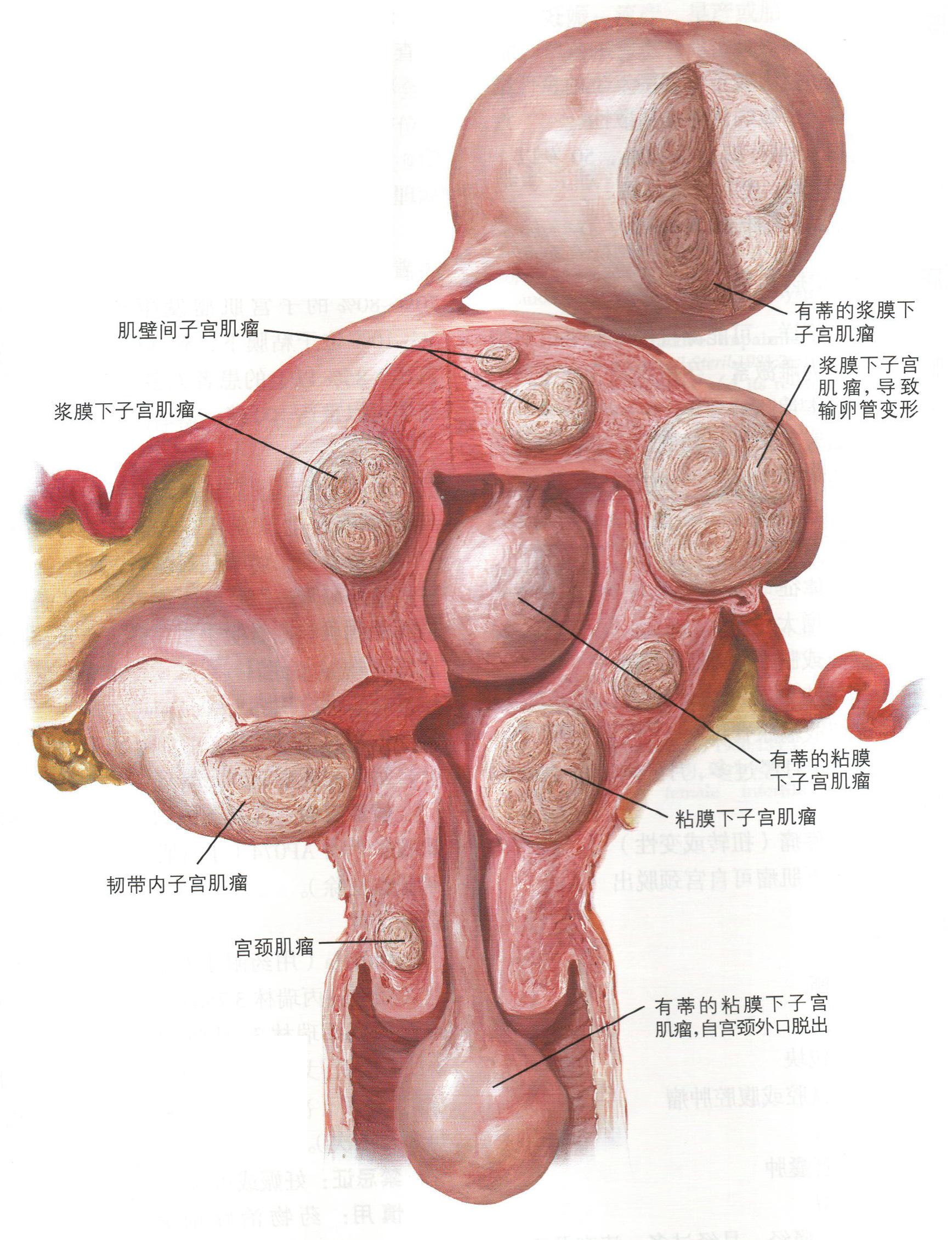 最新最好的子宫腺肌瘤治疗方法