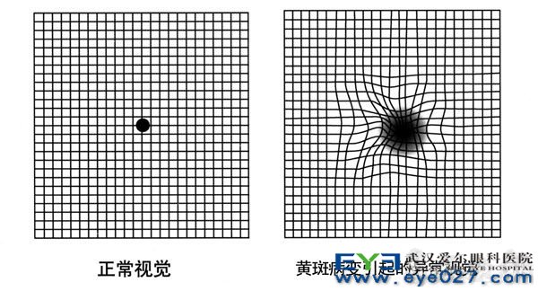 眼底黄斑病最新最有效的治疗方法概述